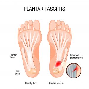 Balance Foot & Ankle - Plantar Fasciitis
